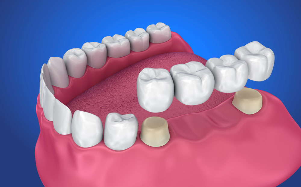 Dentures and Crowns
