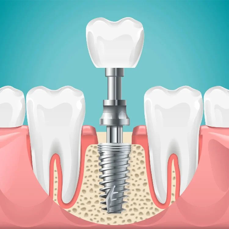 Dental Implants
