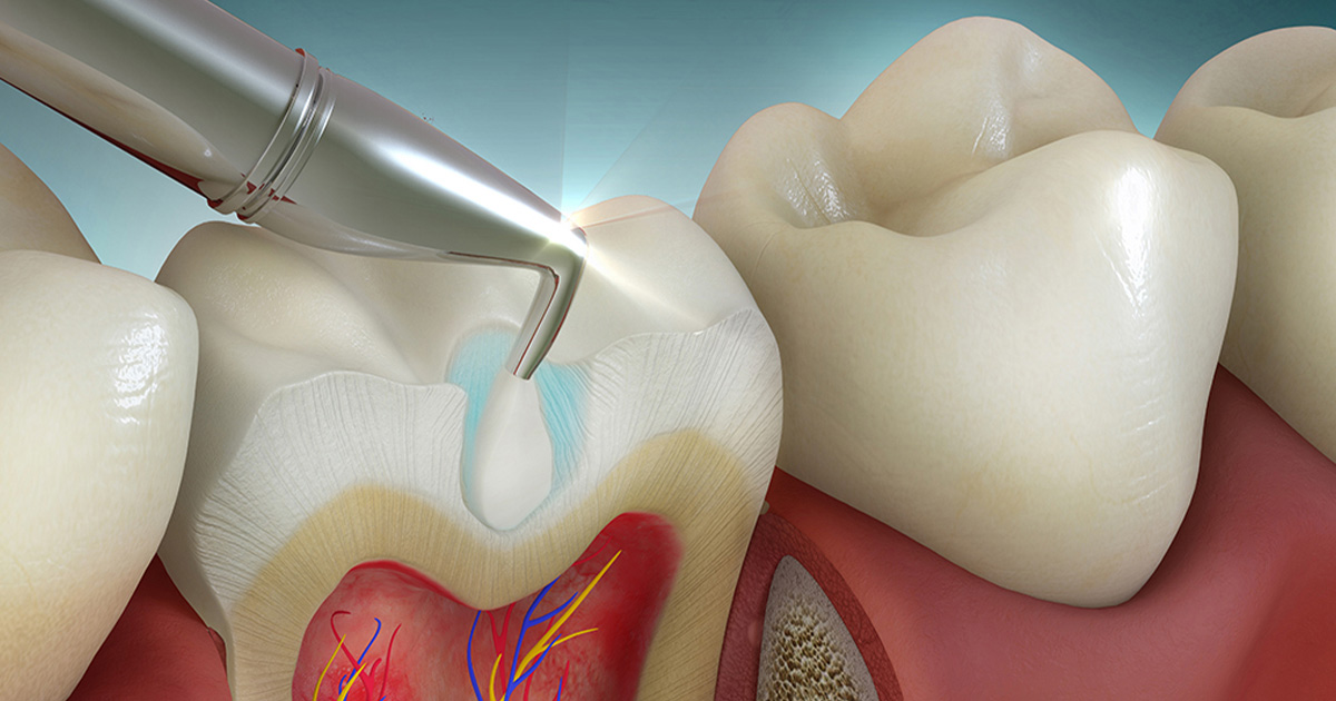 Tooth Colored Restoration